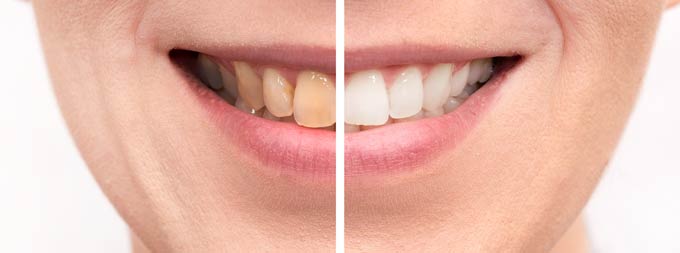 Vorher: Verfärbte Zähne mit sichtbaren Flecken und Gelbstich. Nachher: Strahlend weiße Zähne nach einer erfolgreichen Bleaching-Zahnbehandlung. Ein beeindruckender Wandel zu einem strahlenden Lächeln.